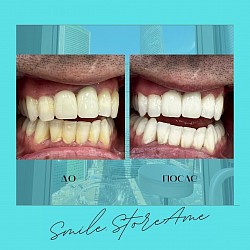 Лазерное Отбеливание зубов Amaizing