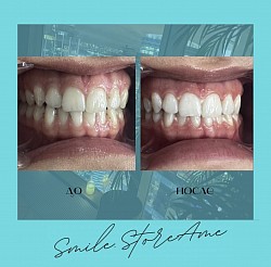 Лазерное Отбеливание зубов Beyond