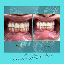 Лазерное отбеливание зубов Amaizing