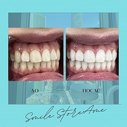 Лазерное Отбеливание зубов Beyond