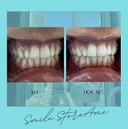 Лазерное отбеливание зубов Beyond