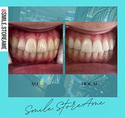 Лазерное отбеливание зубов Amaizing