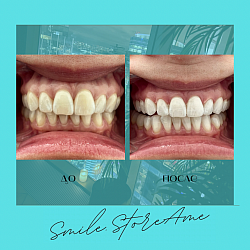 Лазерное Отбеливание зубов Amaizing