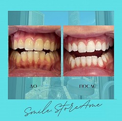 Лазерное Отбеливание зубов Amaizing