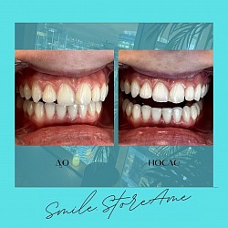 Лазерное Отбеливание зубов Amaizing