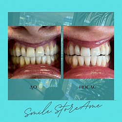 Лазерное отбеливание зубов Amaizing